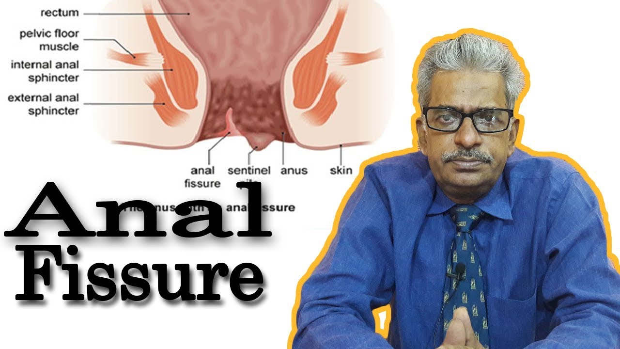 anal fissures to treat fasting