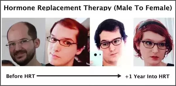 hair transexuals bald regrow