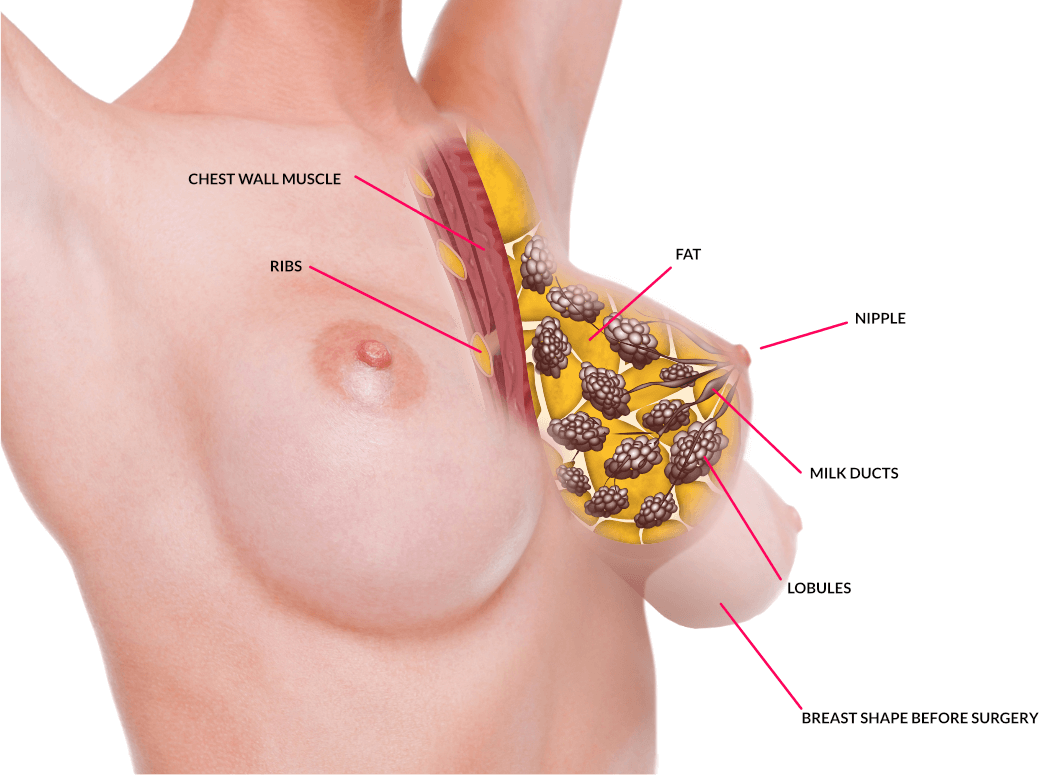 surgery cost breast