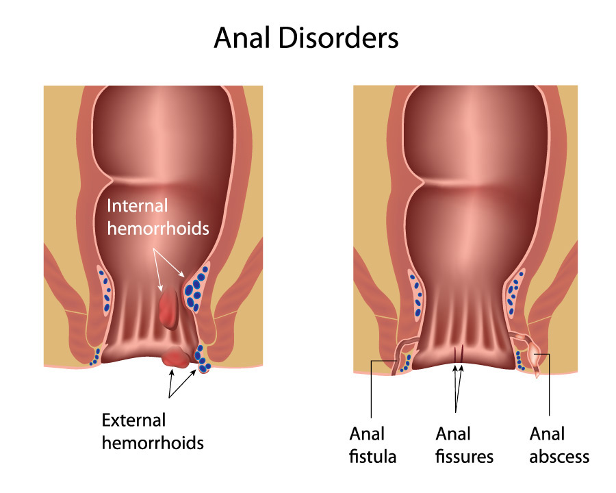 anal disease fissure