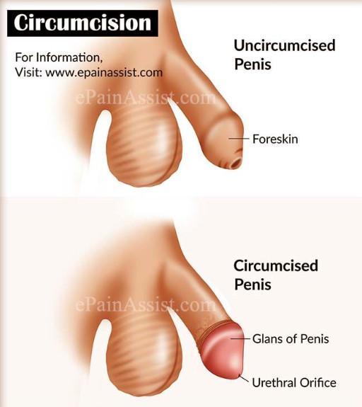 circumcised penises and uncircumcised