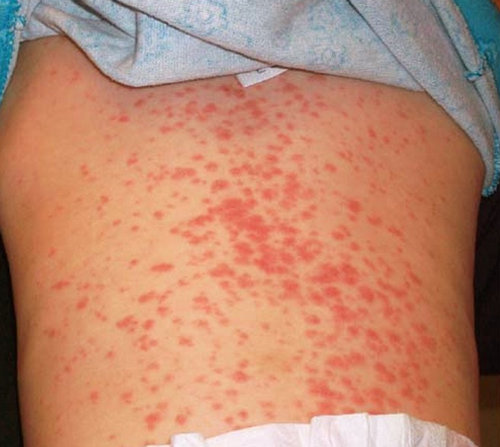 allergic reaction amoxicillin in adults