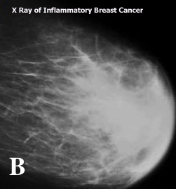 inflammatory period breast cancer