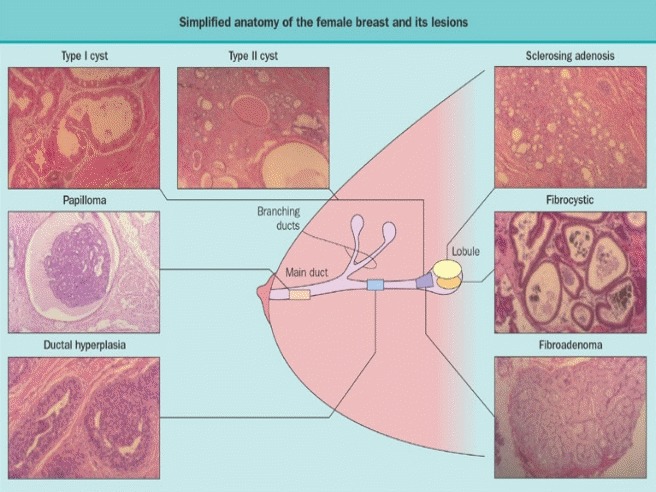 kinds lesions of breast