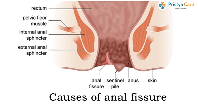 anal disease fissure