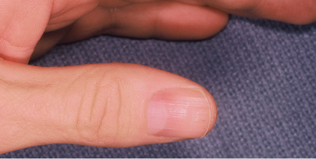 thumb glomus tumor nail under