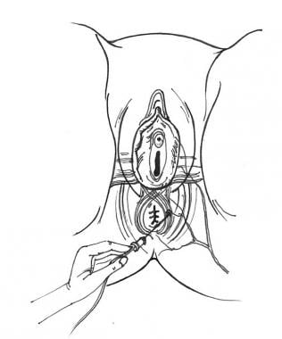 emg urethral sphincter anal