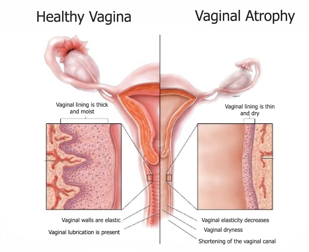 how does last atrophy long vaginal
