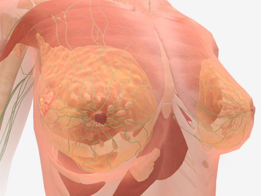 inflammatory period breast cancer