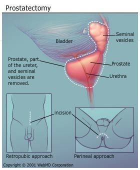 sexual cancer prostate removal