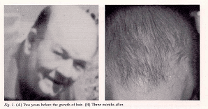 hair transexuals bald regrow