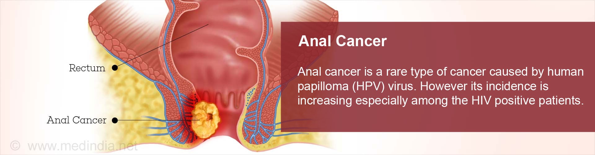 for cancer anal treatment