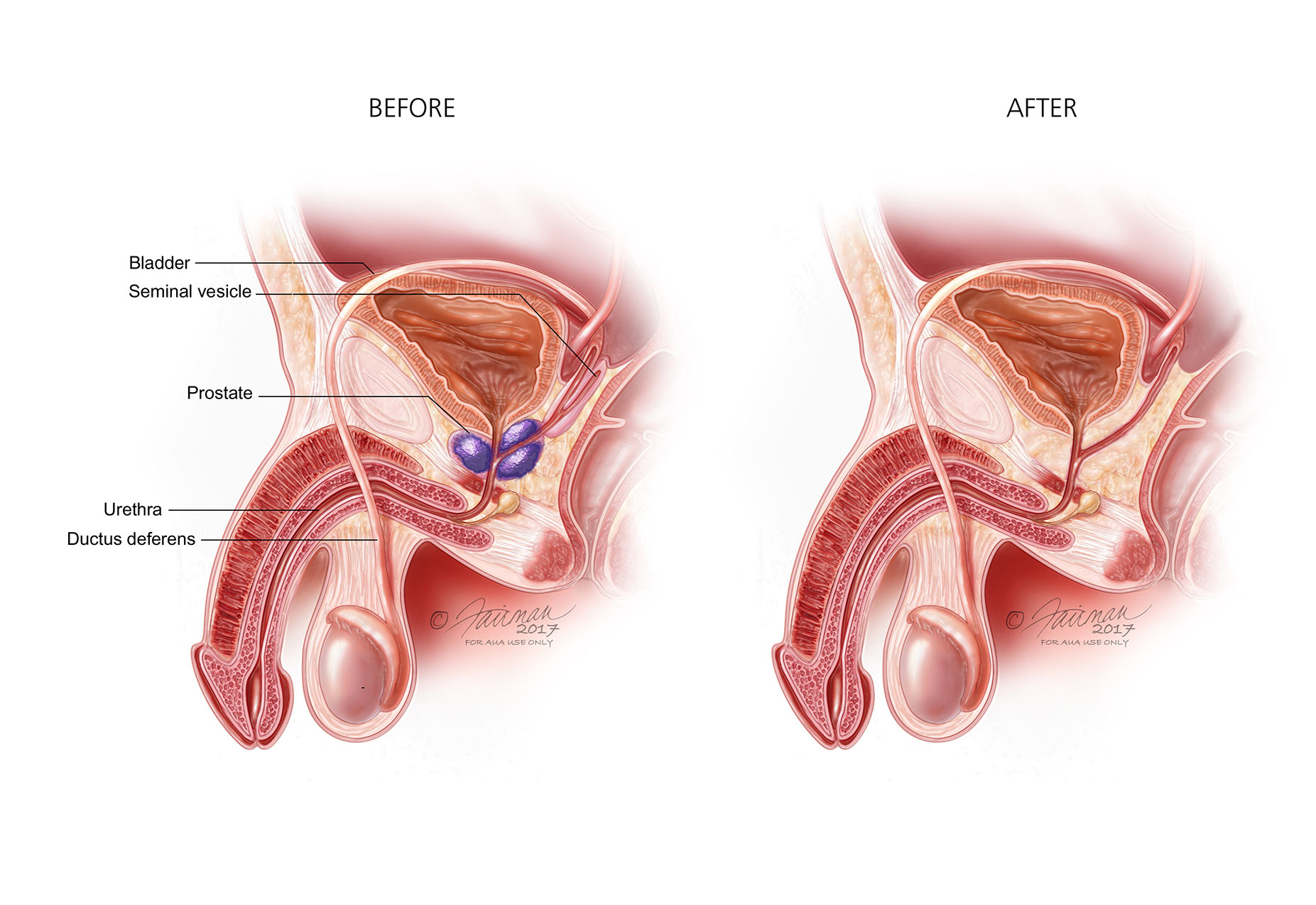 activity prostate sexual surgery