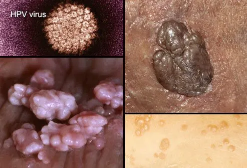 warts vagina genital