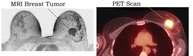 cancer pet breast scan and