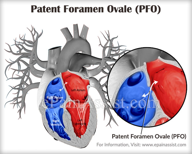 symptoms in patent adults foramen ovale