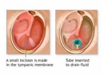 ear ventilation in adults tubes
