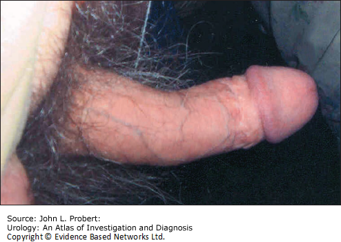 damage urology penis