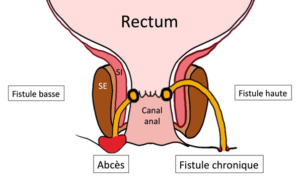 fistule anale irm