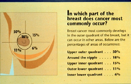upper cancer right outer breast quadrant