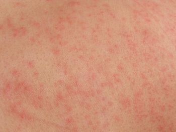 allergic reaction amoxicillin in adults