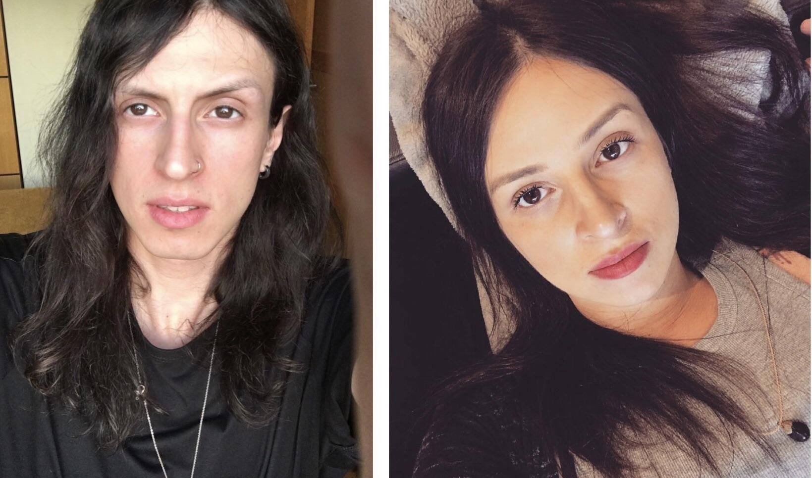 of pictures after before transsexual and operation