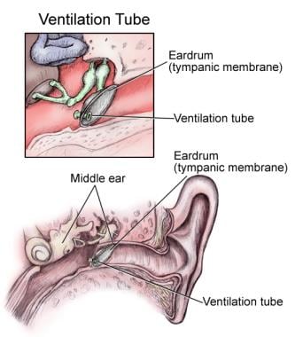 ear ventilation in adults tubes